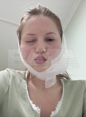 Во Владивостоке девушка хотела удалить зуб мудрости, а получила перекошенное лицо и гнойное воспаление во рту