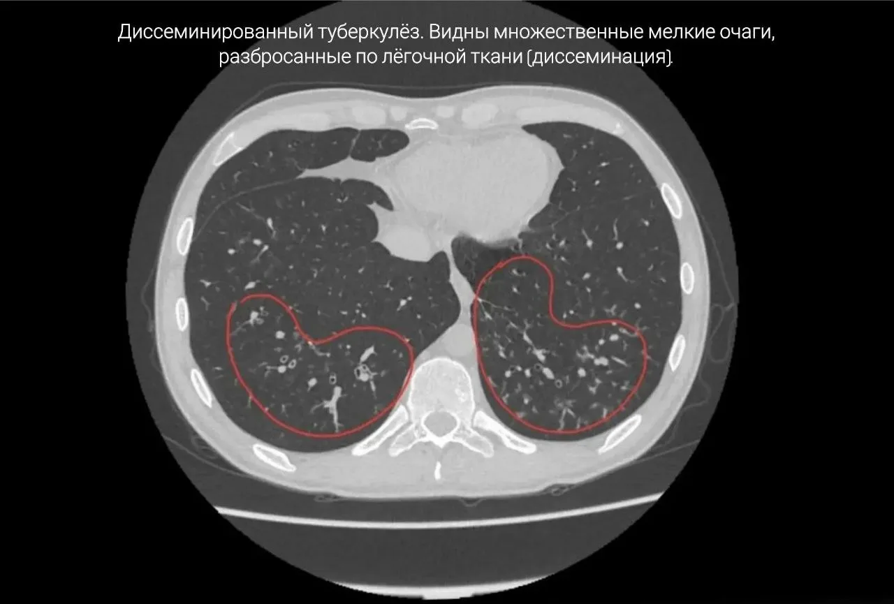17 лет курения свели в могилу: жителя Приморья не удалось спасти после многих лет вейпинга